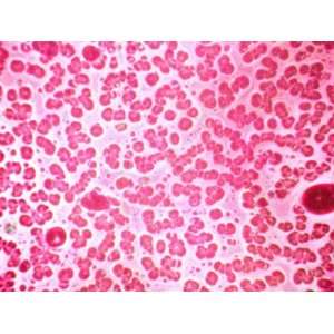  Pernicious Anemia Sample Red Blood Cells Photographic 